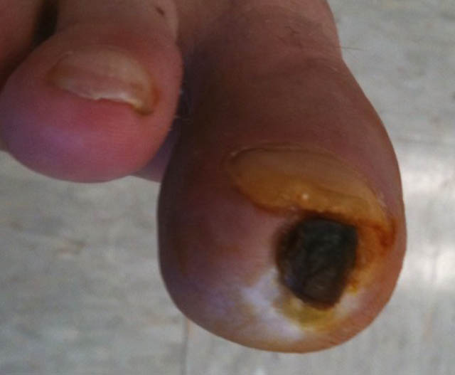 Frostbite: Eight months out. Skin successfully growing over bone and under dead skin cap at end of big toe.
